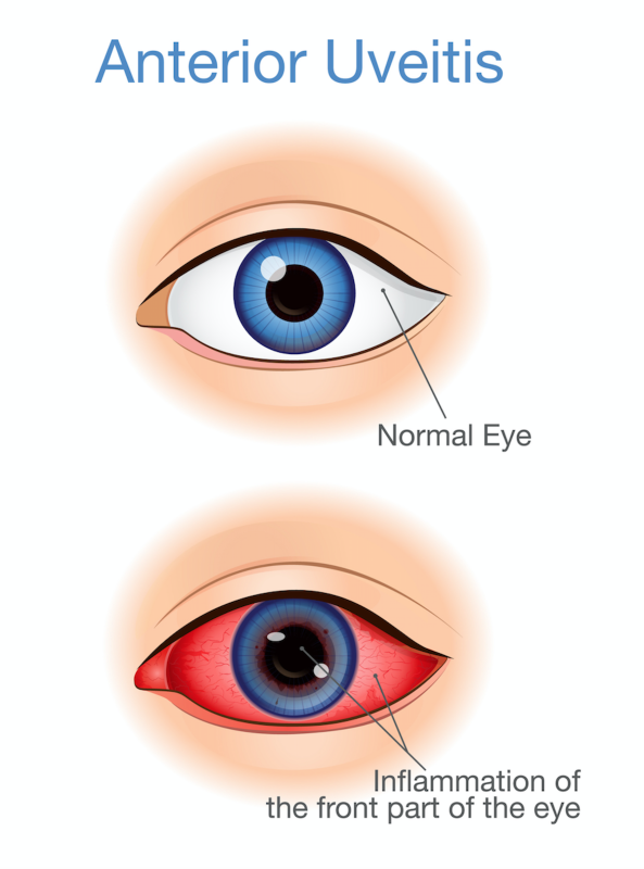 Uveitis Diagram