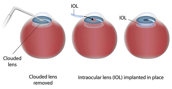 Chart Illustrating Cataract Surgery